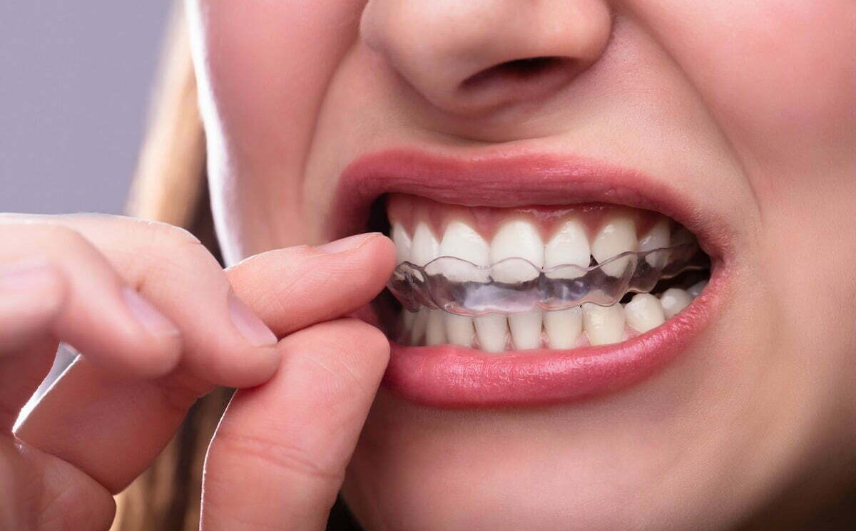 Bruksizm i napięciobóle twarzy. Rola fizjoterapii w planie ortodontycznym